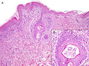 A, Hyperkeratosis with parakeratosis, vacuolization of the basal layer of the epidermis, necrosis of keratinocytes and lymphocytic infiltrate in the dermis (hematoxylin-eosin, original magnification ×10). B, Detail of histologic image showing hair follicle with keratinocyte necrosis (hematoxylin-eosin, original magnification ×40).