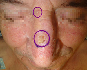Basal cell carcinomas on the dorsum and root of the nose. The circles indicate the size of the surgical defects after excision with adequate margins.