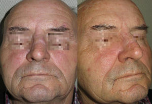 Postoperative result 12 months after the operation.