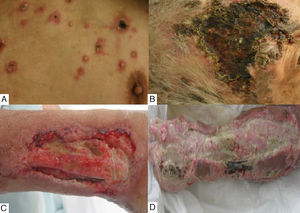 A, Necrotic pustules and papules on the trunk and lower extremities. B, Ulcers and extensive necrosis on the head. C and D, Large ulcers on the left forearm with exposed tendons and muscle.