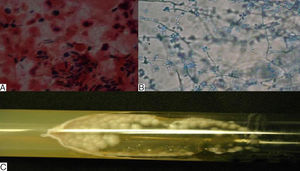 A, PAS-stained smear showing cigar-shaped yeast cells (original magnification ×100). B, Microscopic analysis of the culture showing sympodial conidia (lactophenol blue, original magnification ×40). C, Culture of Sporothrix species.