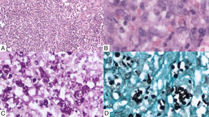 A, Histopathology of skin samples with suppurative granuloma containing lymphocytes, epithelioid histiocytes, and multinucleated giant cells (hematoxylin-eosin, original magnification ×5). B, Higher magnification image showing phagocytosed yeast cells (hematoxylin-eosin, original magnification ×40). C, Note the abundance of yeast cells (PAS, original magnification ×20). D, Ovoid and cigar-shaped yeast cells (Gomori-Grocott, original magnification ×20).
