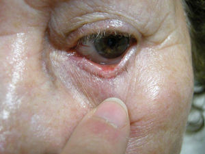 Decrease in lesion size after 4 months of treatment.