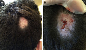 A, Clinical appearance of alopecic nodule of the scalp. B, Drainage of yellowish material after puncture.