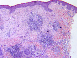 Histopathology: inflammatory lesion in the mid and deep dermis consisting of granulation tissue, edema, reactive angioproliferation, and mixed inflammatory infiltrate, with non-confluent granulomas, some with giant cells and others with central abscess formation (hematoxylin eosin, original magnification ×20).