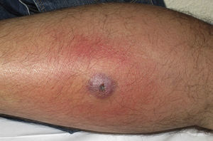 Abscess and perilesional cellulitis.