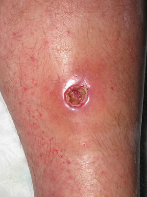 Erythematous-violaceous border and fibrinous center after spontaneous drainage of an abscess on the leg.