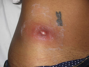 Abscess next to a tattoo on a young woman.