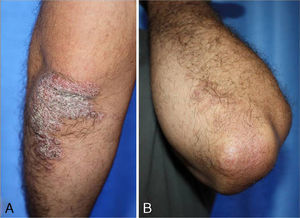 A, Patient 1. Recurrence of psoriasis 30 weeks after initiation of ustekinumab (PASI, 9.8). B, Patient 1. PASI 75 after combining 17 sessions of narrowband UV-B therapy (12.9J/cm2) with ustekinumab (PASI, 2.1). PASI indicates Psoriasis Area and Severity Index.