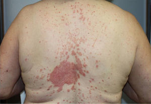 Patient 2. Worsening of psoriasis at 64 weeks after initiation of ustekinumab (Psoriasis Area and Severity Index, 7.8).
