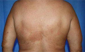 Patient 2. Psoriasis Area and Severity Index 90 response with the combination of ustekinumab and narrowband UV-B phototherapy (15J/cm2 in 16 sessions).