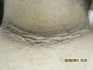 Woman aged 45 years with grade III obesity and grade IV acanthosis nigricans on the neck.