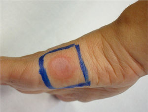 Positive patch test with etoricoxib at 10% in petrolatum in the area previously affected by the fixed drug eruption.