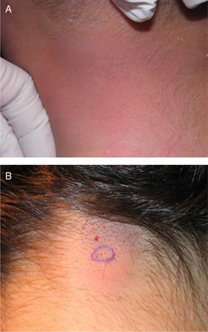 Clinical image of the tumors on the neck of patient 1 (A) and of patient 2 (B).