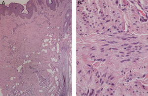 Histopathology image of the tumor. A, at low magnification (original magnification, ×20) and B, a high magnification (original magnification, ×200) (hematoxylin-eosin).