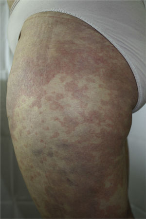 Urticarial rash with an annular morphology that affected around 30% of the body surface area and was most prominent on the proximal third of the lower limbs.