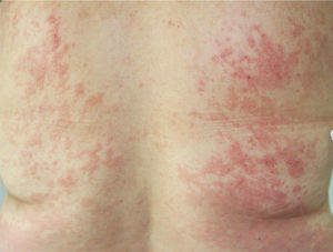 Detail of the lesions on the back.