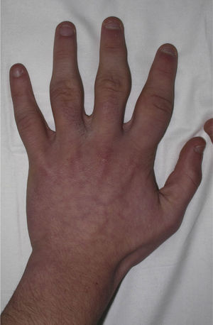 Pretreatment photograph showing the conspicuous, diffuse thickening around the proximal interphalangeal joints of all the fingers with the exception of the thumb and fifth finger.