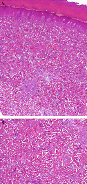 A, Histology image in which thickening of the dermis may be observed, associated with an increase of both collagen fibers and, to a lesser extent, fibroblasts (hematoxylin-eosin, original magnification x10). B, Histology image at higher magnification showing the increase of the collagen fibers and fibroblasts (hematoxylin-eosin, original magnification x20).