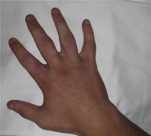 Photograph taken 2 months after the second session of injections. There is a visible reduction in the periarticular swelling and slight hypopigmentation secondary to the treatment.