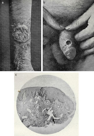 Chronic pyoderma. A, Vegetative pyoderma on the patient's forearm. B, Chancriform pyoderma. C, Photomicrograph of a chancriform pyoderma.