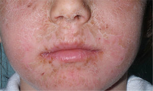 Child with facial allergic contact dermatitis caused by octocrylene.