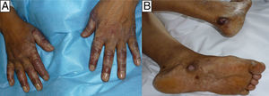 A, Swelling of both hands with poorly defined areas of violaceous erythema on the bony prominences of the fingers. B, Round superficial ulcers with a clean base and hyperpigmented borders on the sole of the right foot and on the left heel.