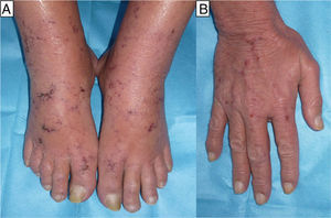 A and B, Bilateral, symmetrical, crusted erosive lesions with a retiform distribution on the dorsum of the feet and hands.