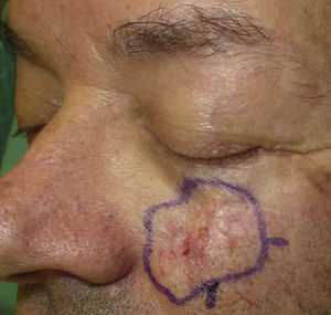 A recurrent sclerodermiform basal cell carcinoma on the scar of a previous operation.