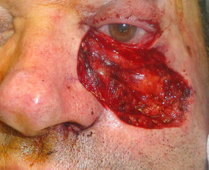 Surgical defect after 8 stages of Mohs micrographic surgery. Despite the absence of the tarsus, it was possible to preserve part of the palpebral conjunctiva, the medial canthus, and the lacrimal apparatus.