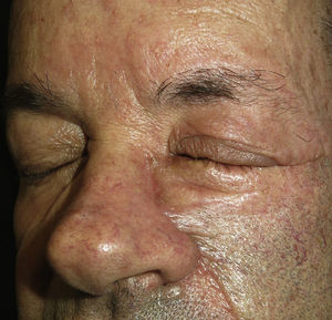 Two months after surgery. Function was good and there was an acceptable cosmetic appearance.