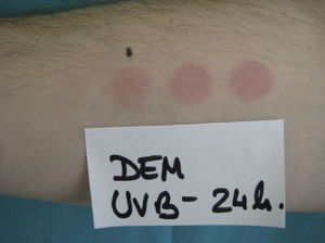 Phototest. Minimal erythema dose (MED) for UV-B radiation. Erythematous response. MED determined using a fluorescent lamp with 5 test fields and a filter to determine the exposure dose according to skin contact time (Gigatest UVB, Medisun).