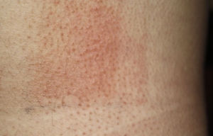 Photoprovocation. Photoprovocation with repeated doses of UV-A radiation applied to the back of a patient with polymorphic light eruption. (Photograph courtesy of Dr. José Aguilera, Faculty of Medicine, Universidad de Málaga, Málaga, Spain).