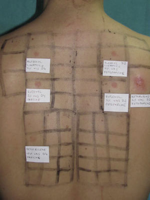 Photopatch test. Panel of UV filters and fragrance mix I components. Allergic contact photodermatitis due to nonsteroidal anti-inflammatory drug: positive photopatch test to ketoprofen. The reaction to octocrylene (UV filter series) in the nonirradiated patch set is probably an irritant reaction and the negative result in the irradiated patch set might be due to an inhibitory UV-A effect.
