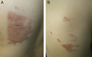 A and B, Subacute dermatitis with a factitious appearance due to occlusive contact with the return electrode, cables, or suction tubes that had become coated with PVP-I in the thoracic surgery operating room (Case 7).
