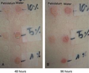 Appearance of the patch tests with different concentrations of PVP-I in petrolatum and water at 48 and 96 hours (Case 2).