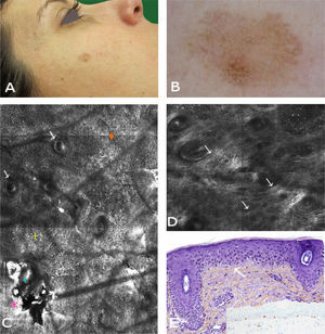 Case 1. A, Photograph. B, Dermoscopic image showing a pseudonetwork with gray dots and a more intensely pigmented eccentric area with focal perifollicular hyperpigmentation. C, Confocal submosaic (1300×800μm) showing an irregular refractile amorphous material () corresponding to hyperkeratosis; loose corneocytes showing disruption of the stratum corneum (); a destructured honeycomb pattern with cells and nuclei of different shapes and sizes, consistent with atypia (); several small (<20μm) isolated dendritic cells (); and no involvement of the follicular openings (↓). D, Confocal submosaic (1100×900μm) showing moderately refractile thickened parallel bundles suggestive of elastosis in the superficial dermis (↓). E, Histologic image showing atypical keratinocytes confined to the lower layers of the epidermis (↓) (hematoxylin-eosin, original magnification ×10), without proliferation of atypical melanocytes (Melan-A, original magnification ×10).