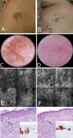 Case 2. A, Photograph showing a pigmented lesion (21×17mm) with irregular borders and a central scar on the left cheek. B, Clockwise mapping of the periphery of the lesion, showing the limits seen by dermoscopy (white line) and confocal microscopy (blue line). Microscopic examination revealed an achromic area with signs compatible with LM. C, Dermoscopic image showing perifollicular pigment and obliteration of the follicular openings () in the pigmented region. D, Slight erythema without dermoscopic signs of LM in the achromatic area. E, Confocal submosaic (1000×1000μm) of the pigmented area showing a destructured honeycomb pattern (), perifollicular hyperpigmentation (), and multiple dendritic cells () in the epidermis. F, Confocal submosaic (1000×1000μm) of the achromatic area showing multiple dendritic cells () in the upper layers and atypical cells in a perifollicular distribution. (). G and H, Histologic image of the pigmented area (hematoxylin-eosin, original magnification ×20) showing nests of atypical melanocytes at the dermal-epidermal junction, with immunohistochemical staining showing follicular involvement (HMB 45, original magnification ×10), and underlying elastosis (*). H, Histologic image of the achromatic area (hematoxylin-eosin, original magnification ×20) showing nests of atypical melanocytes at the dermal-epidermal junction that stained positively with HMB-45 (original magnification ×10) and elastosis in the dermis (*). HMB indicates human melanoma black.