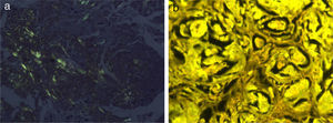 A, Congo red, original magnification ×100. B, Thioflavin T, original magnification ×100.