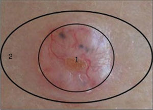 1, Tumor lesion. 2, Healthy perilesional skin.