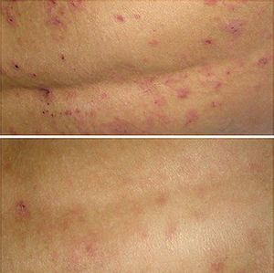 Clinical image of the back of patient number 6. Lesions before (top) and after (bottom) treatment.