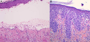 A, Subepidermal blister with a mixed superficial perivascular inflammatory infiltrate with abundant eosinophils (hematoxylin-eosin, original magnification ×210). B, Eosinophilic spongiosis, a frequent histologic feature in early bullous pemphigoid lesions (hematoxylin-eosin, original magnification ×210).