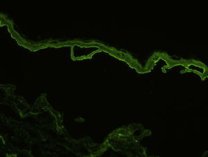 Deposits of circulating anti-basement membrane antibodies in peripheral blood observed by indirect immunofluorescence using salt-split human skin substrate (original magnification ×200).