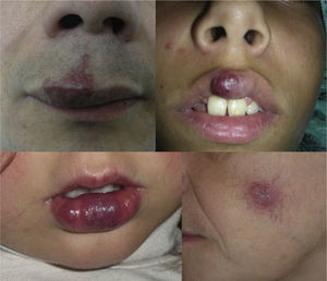 Ateriovenous malformations. Lesions can progress rapidly at birth or appear later.