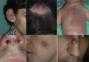 Ateriovenous malformations. Clinical presentation can be very variable, leading to diagnostic difficulty on physical examination.