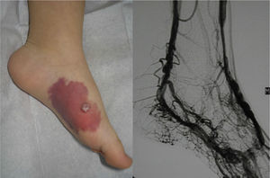 Nodular lesion of recent appearance on a capillary malformation. Arteriovenous malformation.