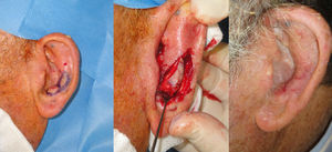 Chondrocutaneous subcutaneous pedicled V-Y flap with a superior vertex on the helix.
