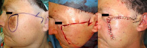 Advancement-rotation flap combined with a Z-plasty.