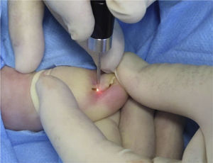 Partial nail matricectomy with carbon dioxide laser.