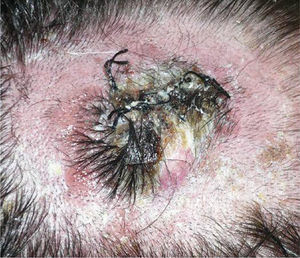 Fast-growing tuberous lesion in the left parietal region.